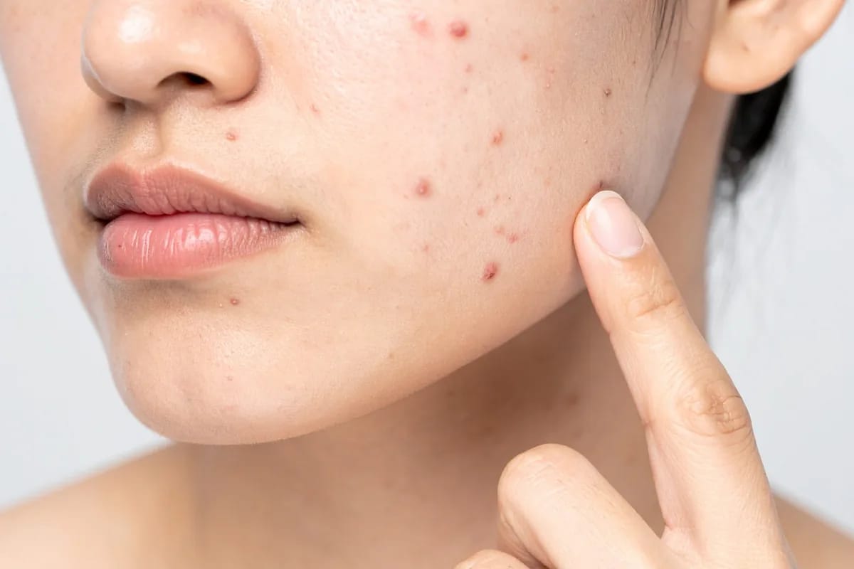 Skin Whitening Treatment — Dr. Negi's Clinic, Uttam Nagar Delhi